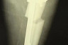  В Саратовской области культиватор раздробил пьяному мужчине ногу